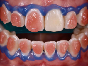 aclaramiento dental 1 hrs.
