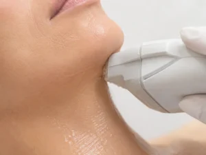 hifu cara y cuello