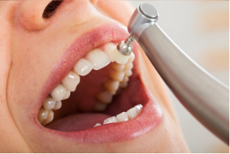 limpieza dental 30 min.