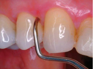 pulido radicular 30 min.