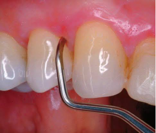 pulido radicular 30 min.