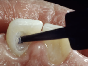 aclaramiento dental interno