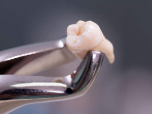 exodoncia tercer molar semiretenido o retenido