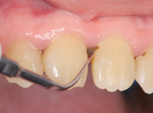 profilaxis dental + destartraje