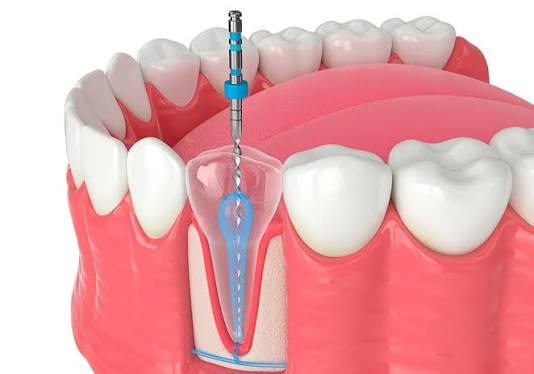 endodoncia