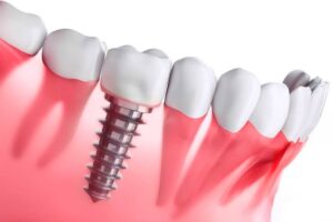 implantes